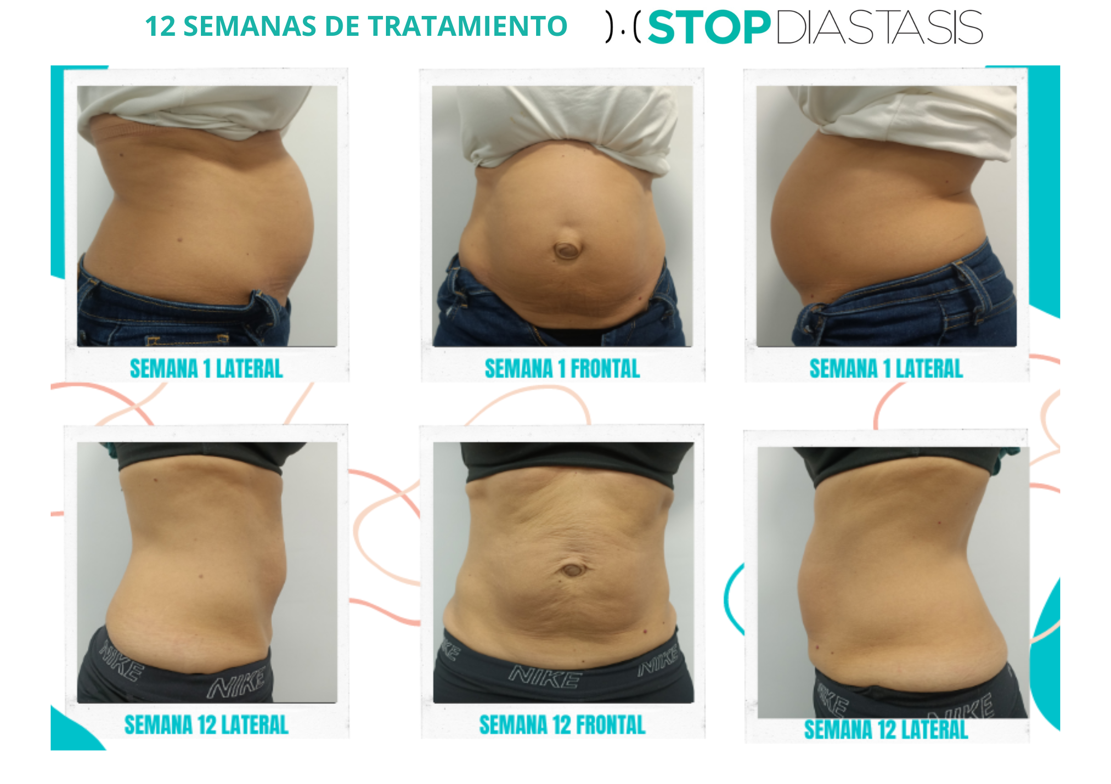 Perfil lateral del abdomen antes de comenzar el programa de 12 semanas