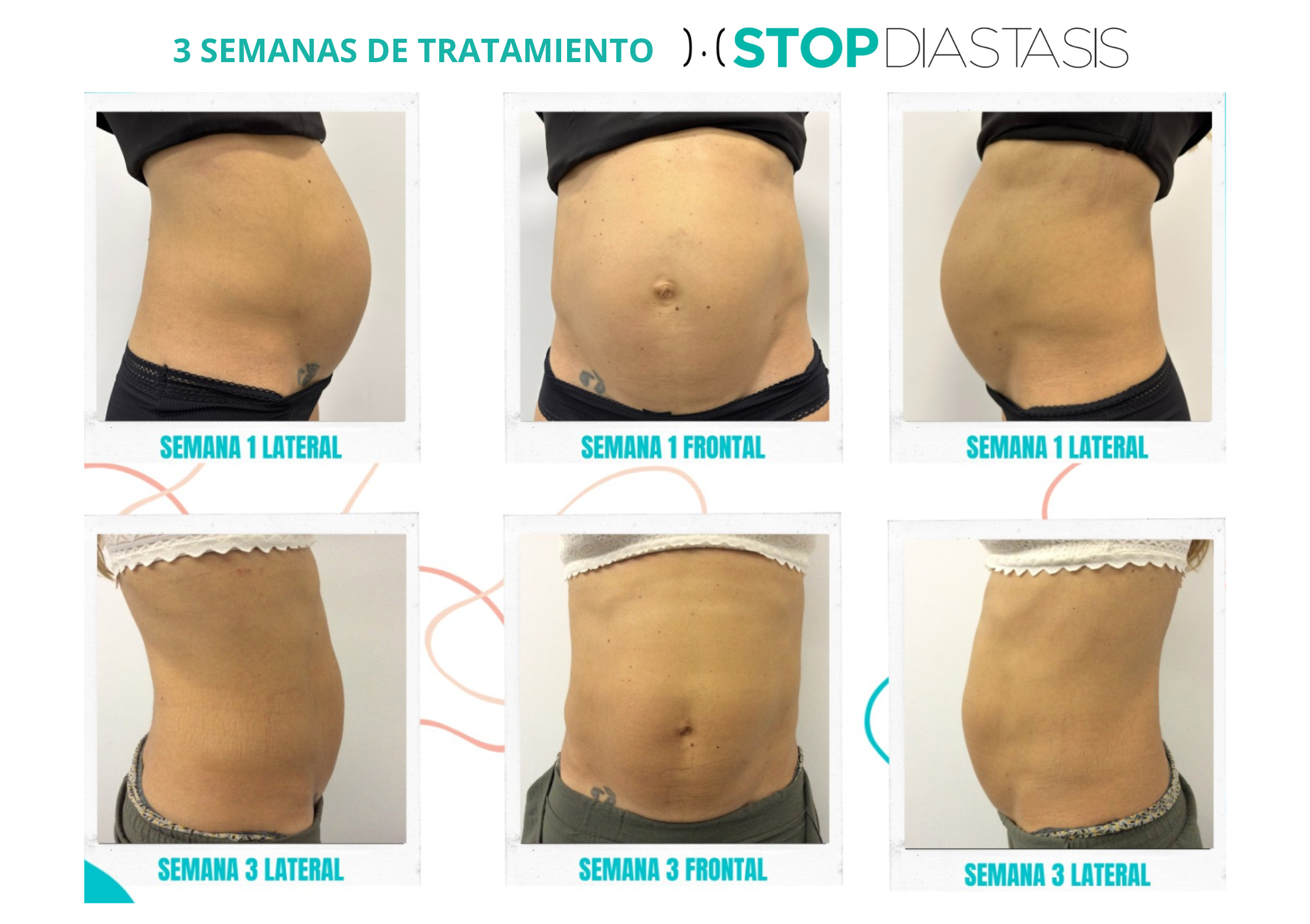 Comparativa antes y después de un caso real de diástasis abdominal tras 3 semanas de tratamiento