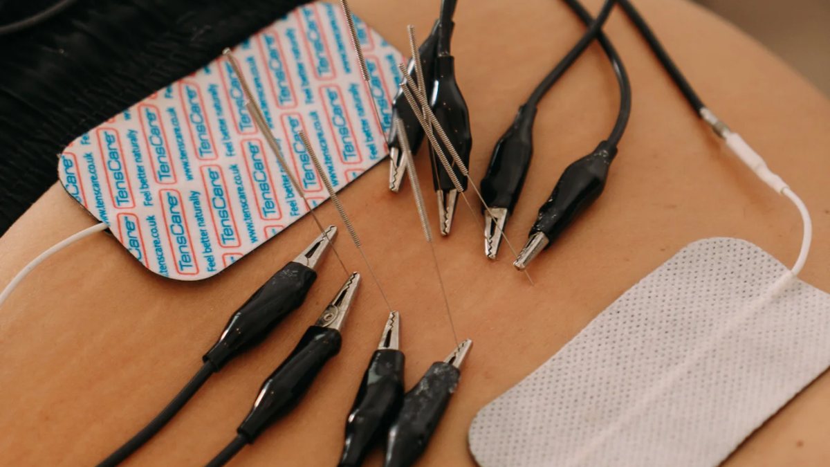 Neuromodulación percutánea ecoguiada en la zona lumbar durante una sesión en Clínica Motriz, Tres Cantos